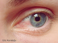 Göz ve Göz Kapağı Kuruluğu Nedir? Belirtisi ve Tedavisi Nasıl Olur? 