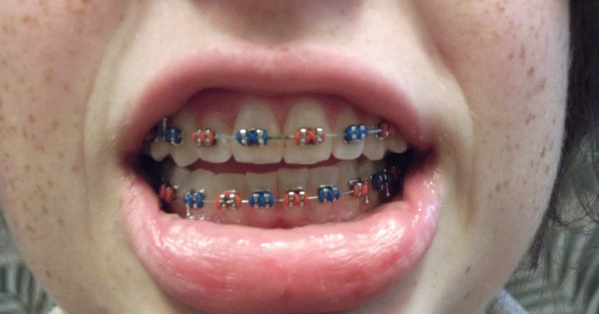 Braces Experience 4 Month Update