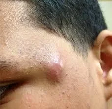 Home Remedy For Sebaceous Cysts