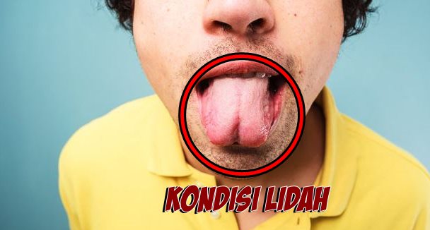 Beragam Gangguan Kesehatan Dilihat dari Kondisi Lidah