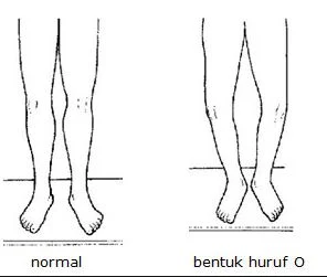 cara memperbaiki bentuk kaki O