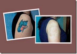 laser tatoo removal