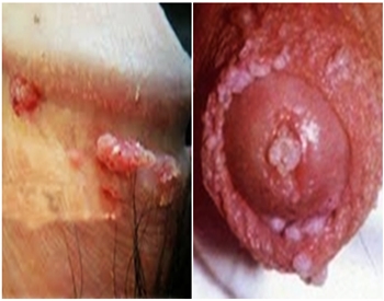 Pengobatan Alternatif Virus Hpv