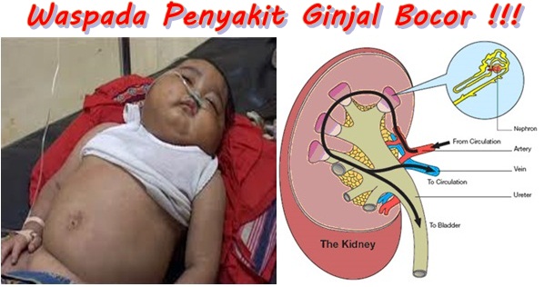 obat ginjal bocor herbal