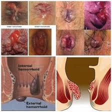 http://solusikeluargaanda.blogspot.com/2014/11/penyakit-ambeien-dan-obatnya.html