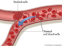 Bahaya penyakit anemia dan cara mengobatinya