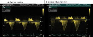 Hypertrophic cardiomyopathy diagnosis