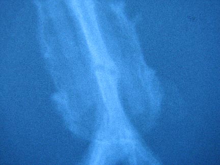 This x-ray was taken after she