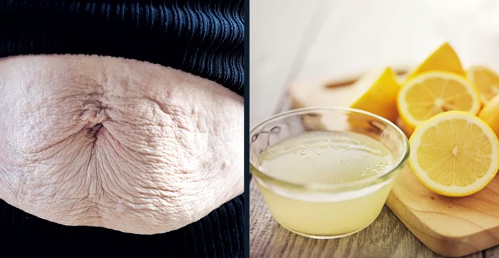 An Old Lemon That Clears Stretch Marks And Gives You Skin Lifted And Pretty