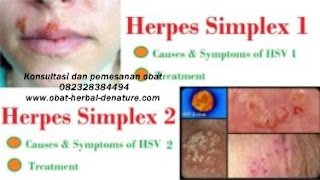 obat herpes kelamin,obat herpes zoster,obat cacar dompo,obat cacar air,obat herpes kemaluan,obat herpes tangan,obat herpes bibir,obat herpes badan