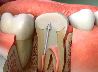 Lấy tủy răng có hại và ảnh hưởng gì không?