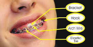 Những vật nha sĩ thường yêu cầu trong niềng răng