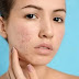 Acne - Types,Causes,Treatment and Prevention