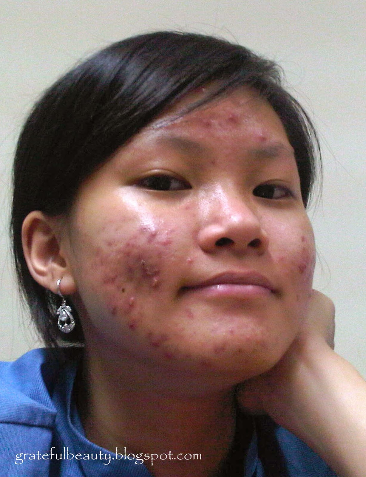 My Acne Story Perjuangan Melawan Jerawat Kornelia Luciana