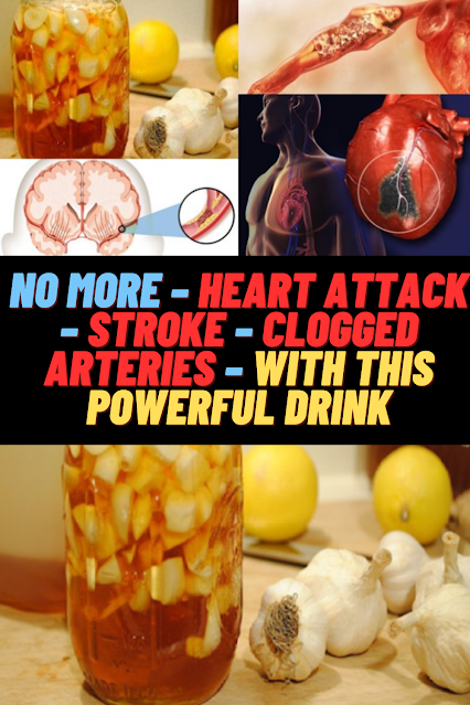 No More – Heart Attack – Stroke – Clogged Arteries – With This Powerful Drink