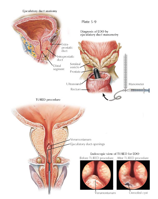 EJACULATORY DUCT OBSTRUCTION