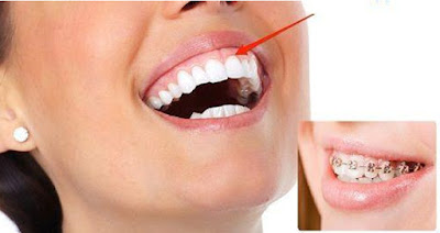Dấu hiệu nhận biết niềng răng xong bị hở lợi 1
