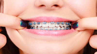 Ưu điểm và hạn chế niềng răng mắc cài kim loại thường 2