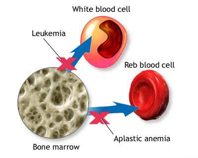 Aplastic Anemia, Diet, Bone Marrow, Read blood cell