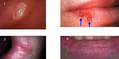 Bibir bengkak merupakan kondisi yang bisa merusak penampilan seseorang, ini juga tak jarang begitu menyakitkan.berikut penyebab bibir bengkak dan cara ampuhnya.