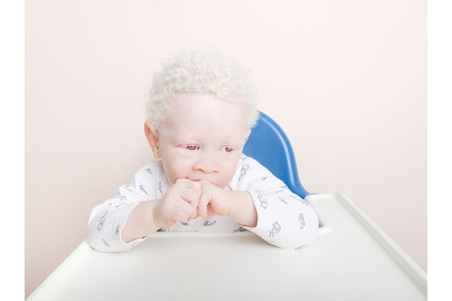 Albinism – На этих детей охотятся и отрезают конечности