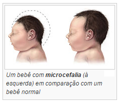 Microcefalia, o que vem a ser?