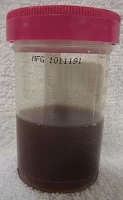 Haematuria