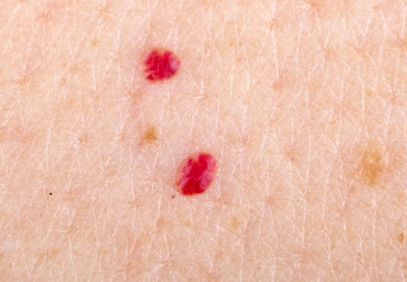  13 Weird Skin Spots You Should Definitely Get Checked Out