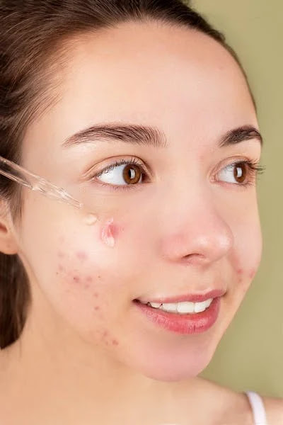 How Acne Treatment Possible At Home
