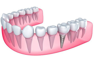 Quy trình trồng răng implant có công nghệ tiên tiến nhất 2017