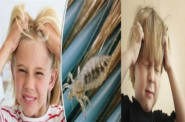 Head lice