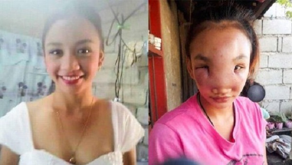 Gegara Pencet Jerawat di Hidung, Wajah Wanita Ini Jadi Mengerikan: Mata Buta dan Wajah Bengkak