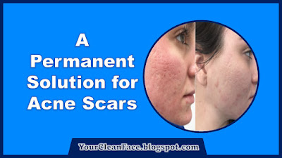 A Permanent Solution for Acne Scars