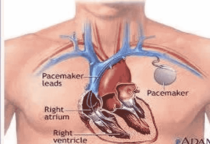Pacemaker therapy in elderly patient: survival, Thiruvananthapuram, News, Pacemaker Therapy, Elderly Patient, Treatment, Health, Health Minister, Veena George, Medical College, Kerala News