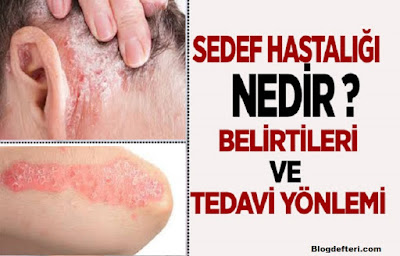 Farklı Sedef Türleri nelerdir?