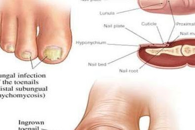 HOW TO GET RID OF TOENAIL FUNGUS USING JUST 3 SIMPLE HOME REMEDIES