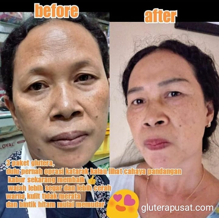 Testimoni Glutera Surabaya