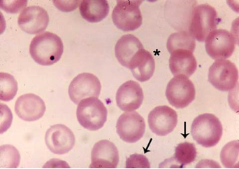  Gambar  Kelainan Eritrosit  Erytrosit Abnormal 