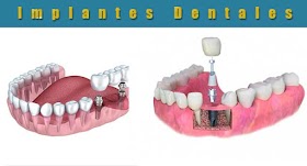 Implantes Dentales Barcelona - Los Mejores Seguros Médicos 