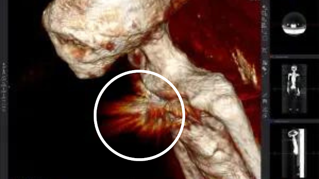 Photo taken whilst the Nazca Mummy was X-Rayed showing a energy light coming from the region where the implant is.