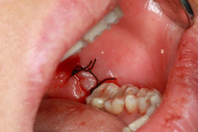 Làm gì khi mọc răng khôn bị chảy máu?