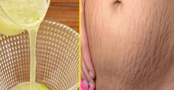 An Old Lemon Trick To Remove Stretch Marks At Home 