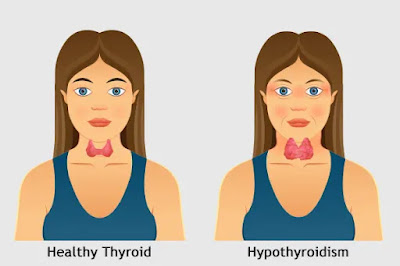 Connection Between CKD & Hypothyroidism