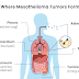 Stage 1 Mesothelioma Survival Rates