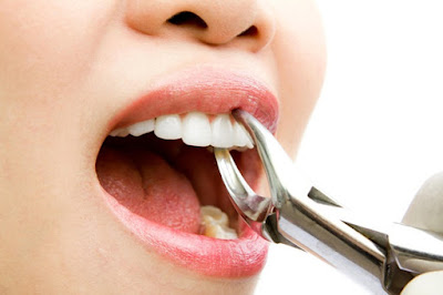 Những lưu ý sau khi nhổ răng bạn cần biết 