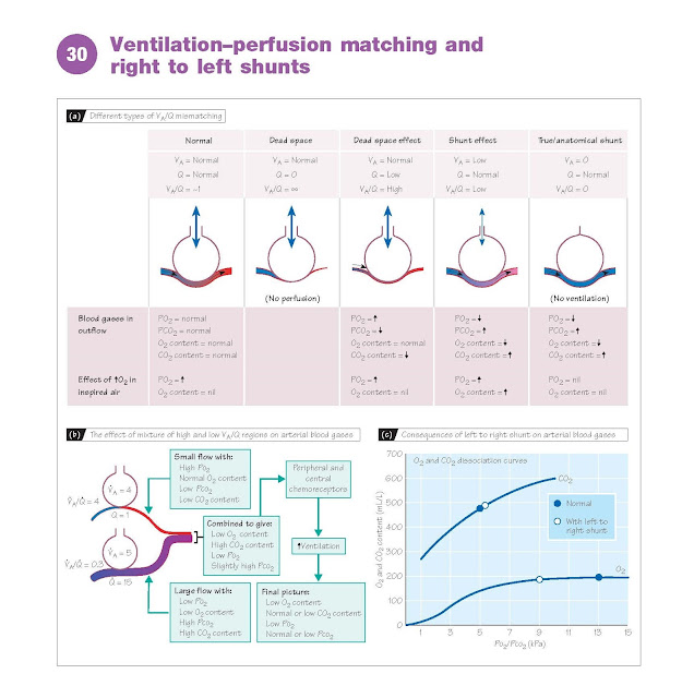 Ventilation–Perfusion  Matching  And Right To Left Shunts