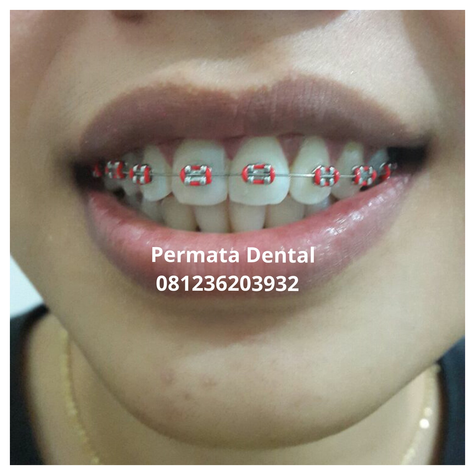 Klinik Gigi Jember Permata Dental Behel  Bracket 