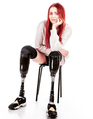 double amputee model who lost her two legs to flesh eating bugs