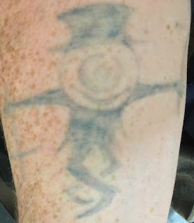 Tattoo moments before Picosure laser removal