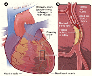 heart during heart attack